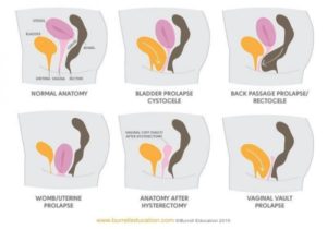 Pictures of different levels of pelvic floor prolapse.